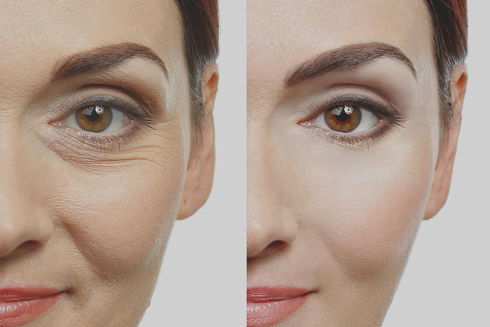 Split image shows a woman's facial transformation by Face of Jules, Los Angeles—fewer wrinkles and smoother skin on the right.