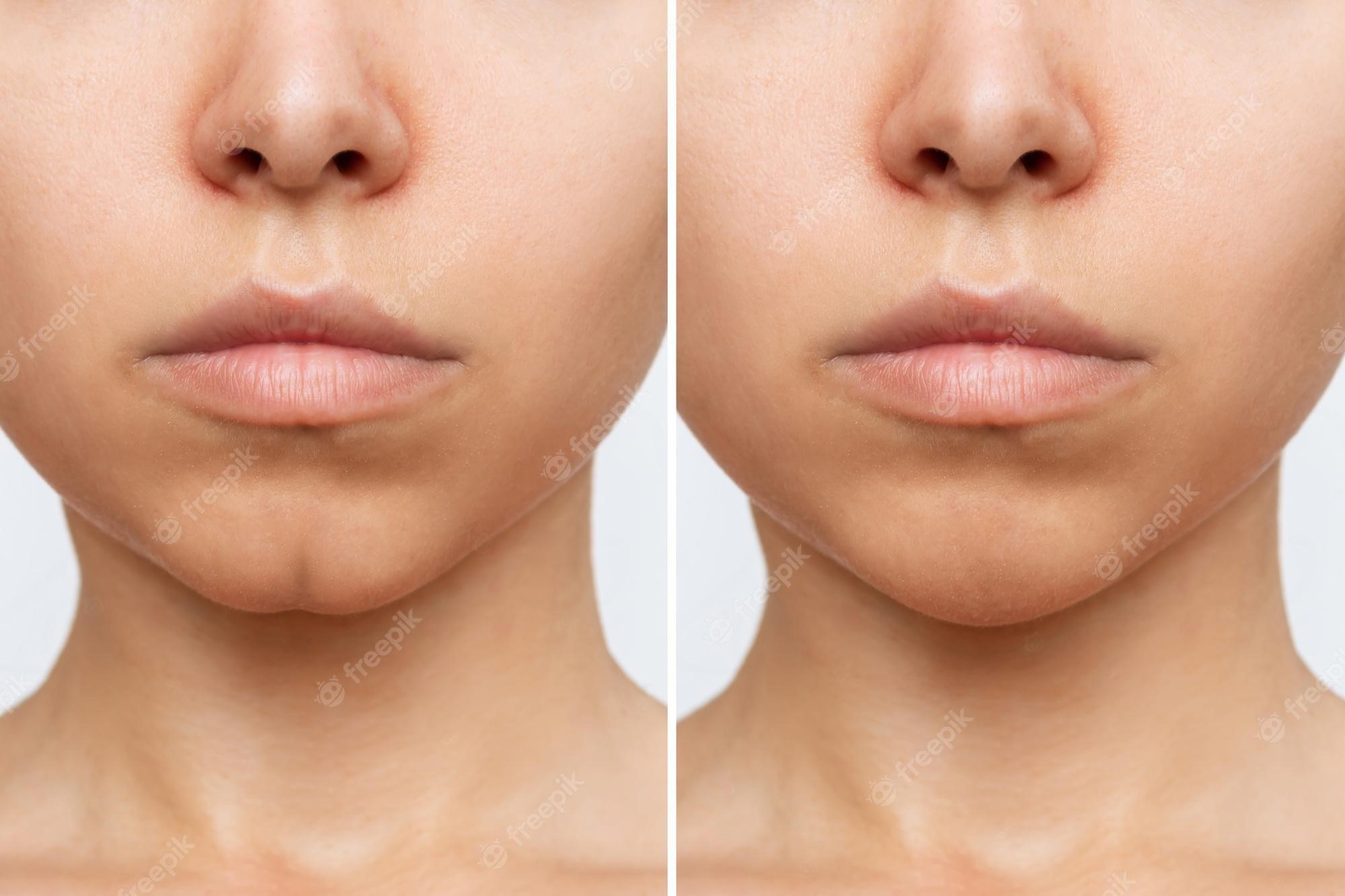 Exploring the World of Dermal Fillers: Types, Benefits, and Costs