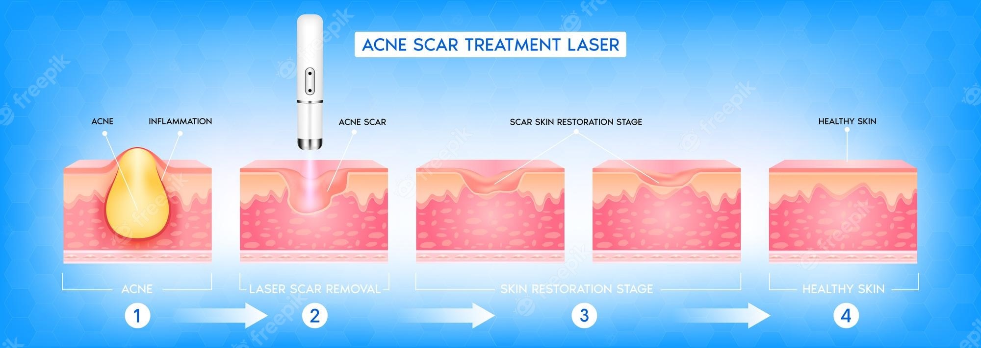 A Comprehensive Guide to Fraxel Laser Treatment for Acne Scars – Face of Jules