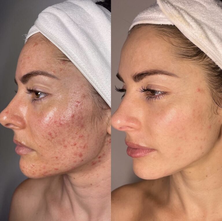 Side-by-side of a woman’s face at Face of Jules in Los Angeles showing best acne treatment results.