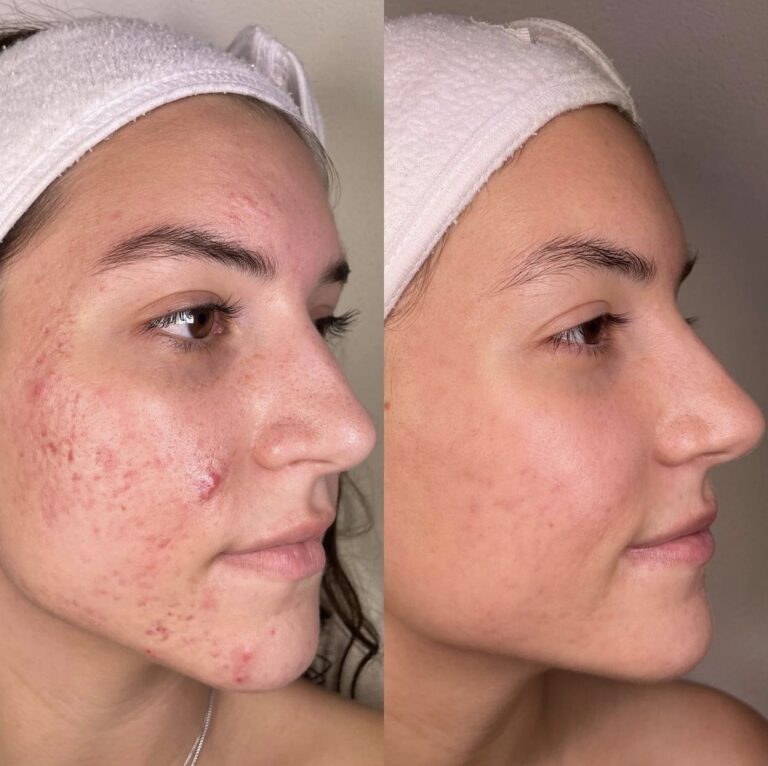 Side-by-side of a woman's face showing acne before and clear skin after treatment in Los Angeles, both wearing a white headband.