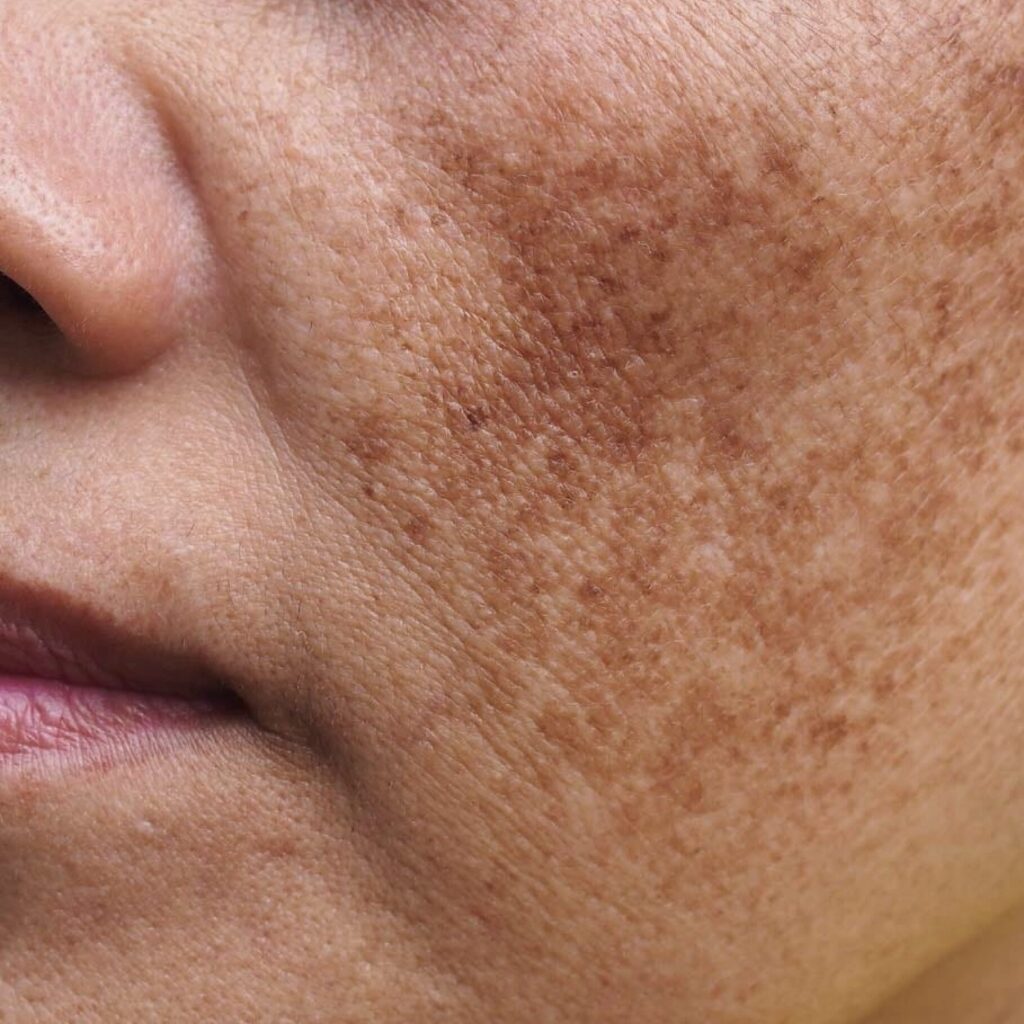 A close-up of a person's cheek showing dark spots and hyperpigmentation after a Hollywood facial.