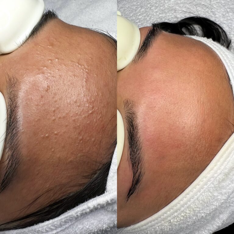 Close-up of a forehead before and after a Hollywood facial, revealing smoother, clearer skin and reduced texture.