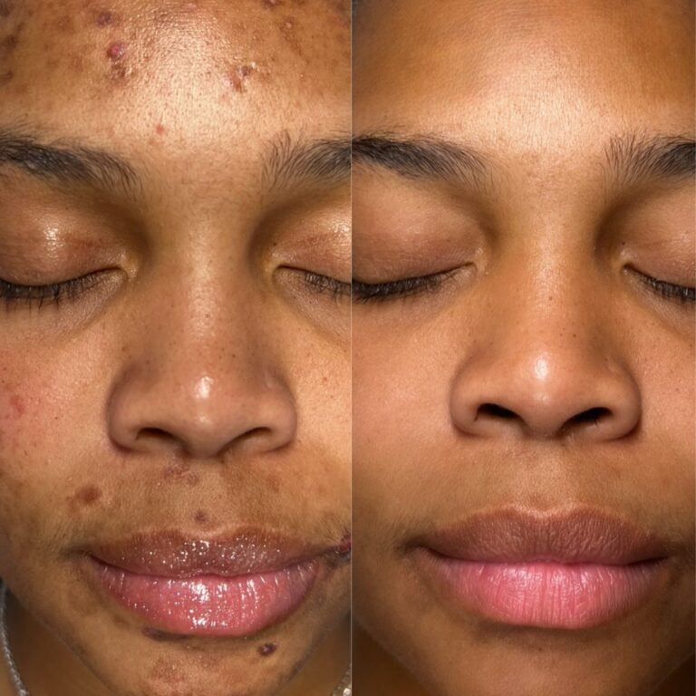 Side-by-side closeups of the Face of Jules in Los Angeles, showing acne before and clearer skin after.