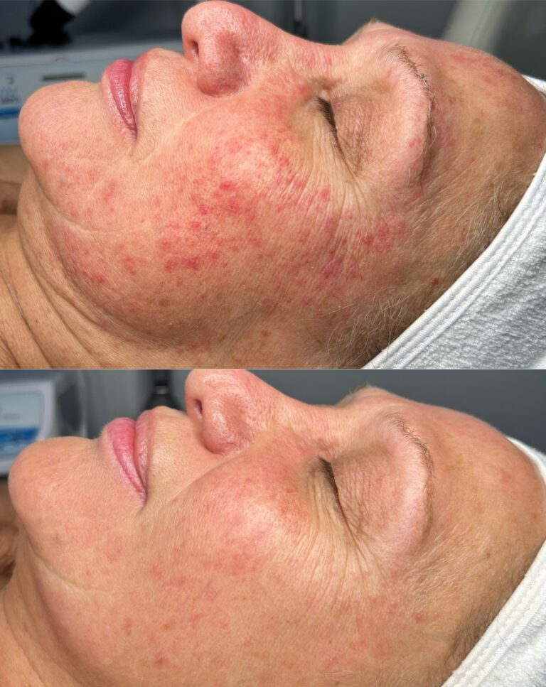 Side-by-side images of a woman's face before and after body treatment, showing reduced redness, fewer blemishes, and smoother skin in the after photo. She is lying down with eyes closed, wearing a white headband.
