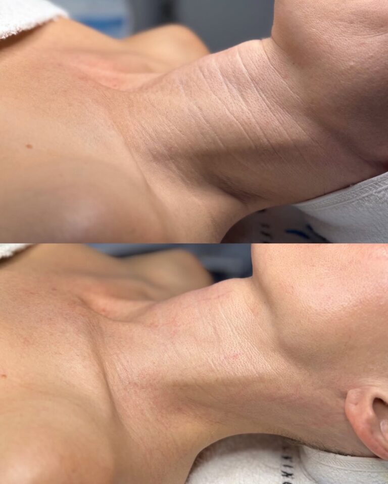 Two close-up photos of a person’s neck, showing a before image with visible wrinkles and an after image with smoother, firmer skin following a body treatment.