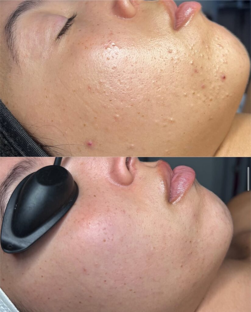 Two close-up side views of a person's cheek and jaw: the top shows acne and texture, while the bottom shows smoother, clearer skin after a body treatment. The person wears eye protection in the lower image, highlighting visible improvements that could be tracked with a treatment questionnaire.