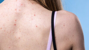 Overcome Back Acne